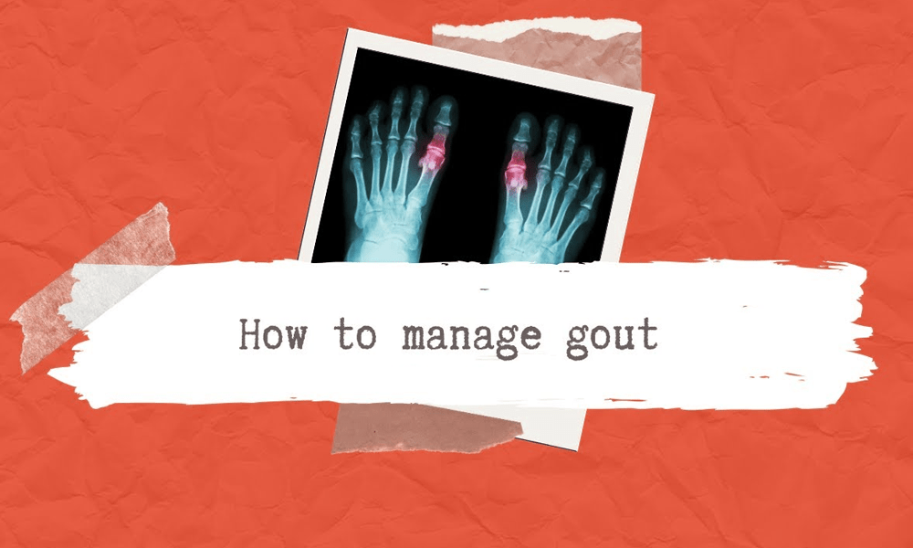 A Five-Minute Guide to Managing and Preventing Gout